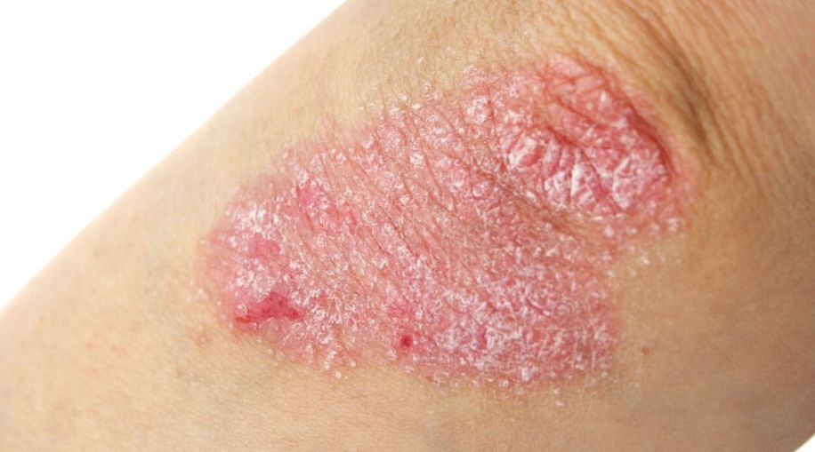 An elbow covered in psoriasis.